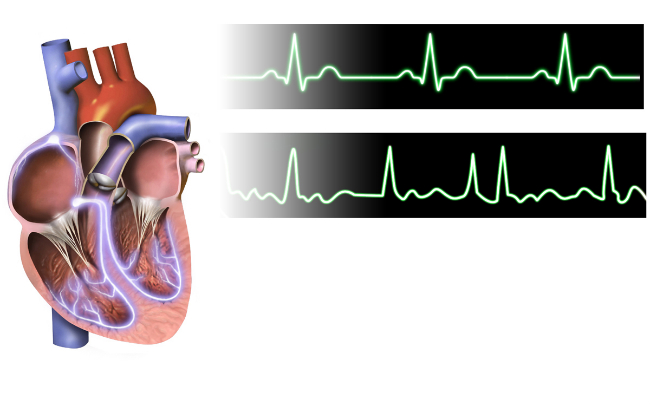 What are the Treatment Options for Afib?